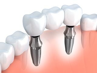 implant bridge