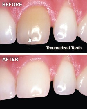 Whitening traumatized teeth.