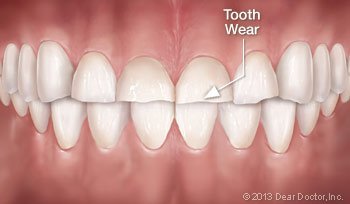 Tooth wear.