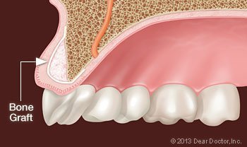 Bone graft.