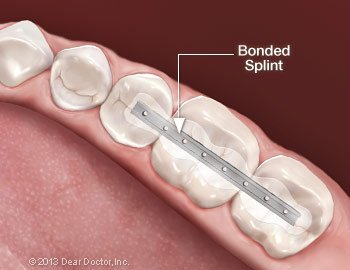 Splinting teeth.