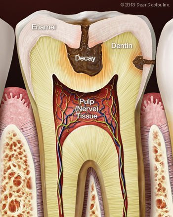 Tooth Decay.