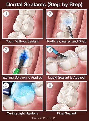 Dental Sealants - Step by Step.