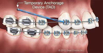 Temporary Anchorage Devices (TADS).