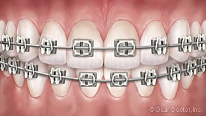 Traditional Metal Braces.